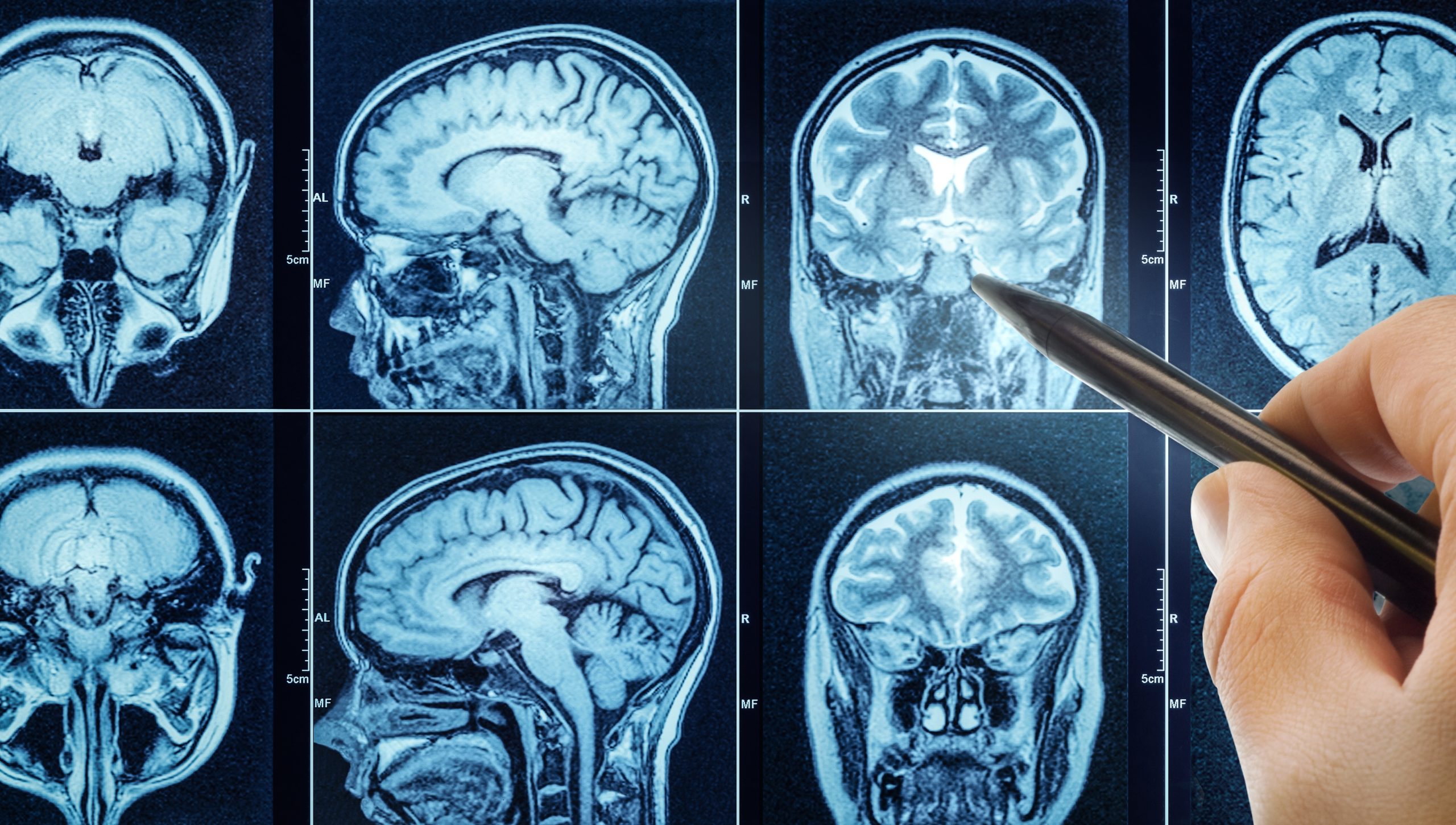 Advanced Alzheimers Patient Shows Remarkable Recovery After Psilocybin Treatment