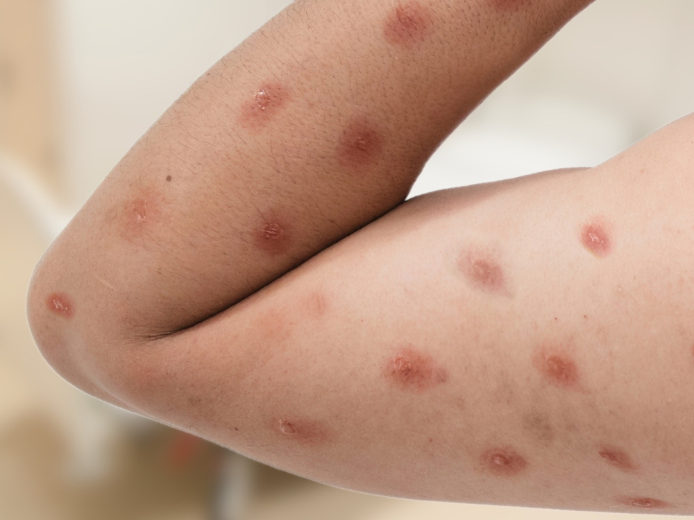 2nd Case of Dangerous Monkeypox Strain Confirmed in LA County