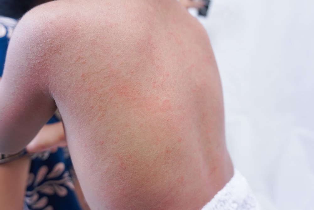 Why Small Red Dots Show Up on the Skin and When to Pay Attention