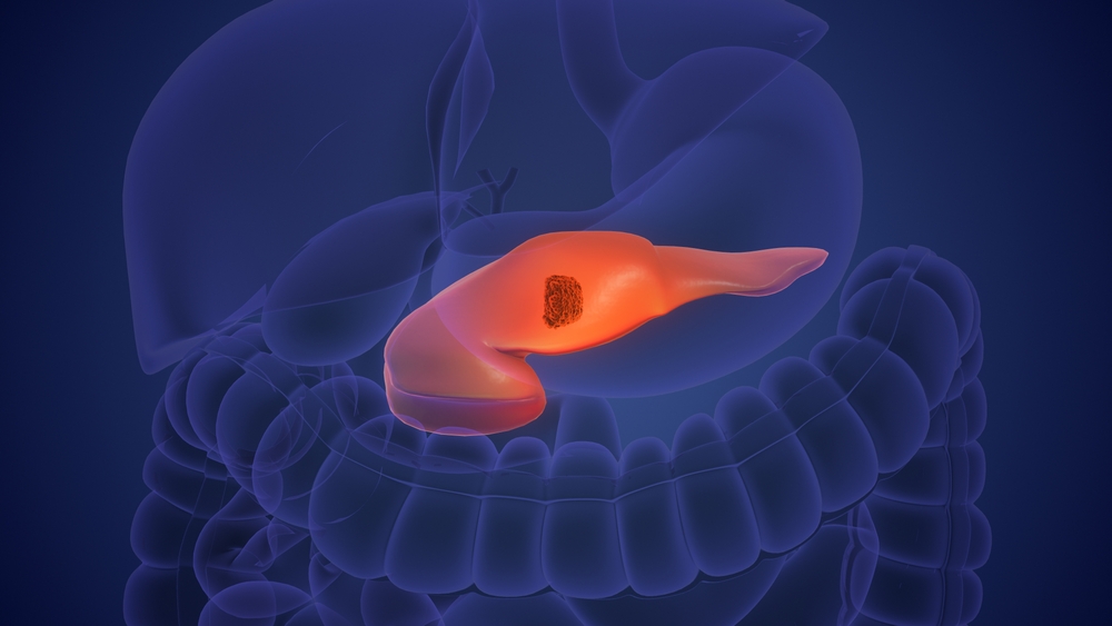 How a Spanish Lab Made Pancreatic Tumors Disappear in Mice Without Triggering Resistance
