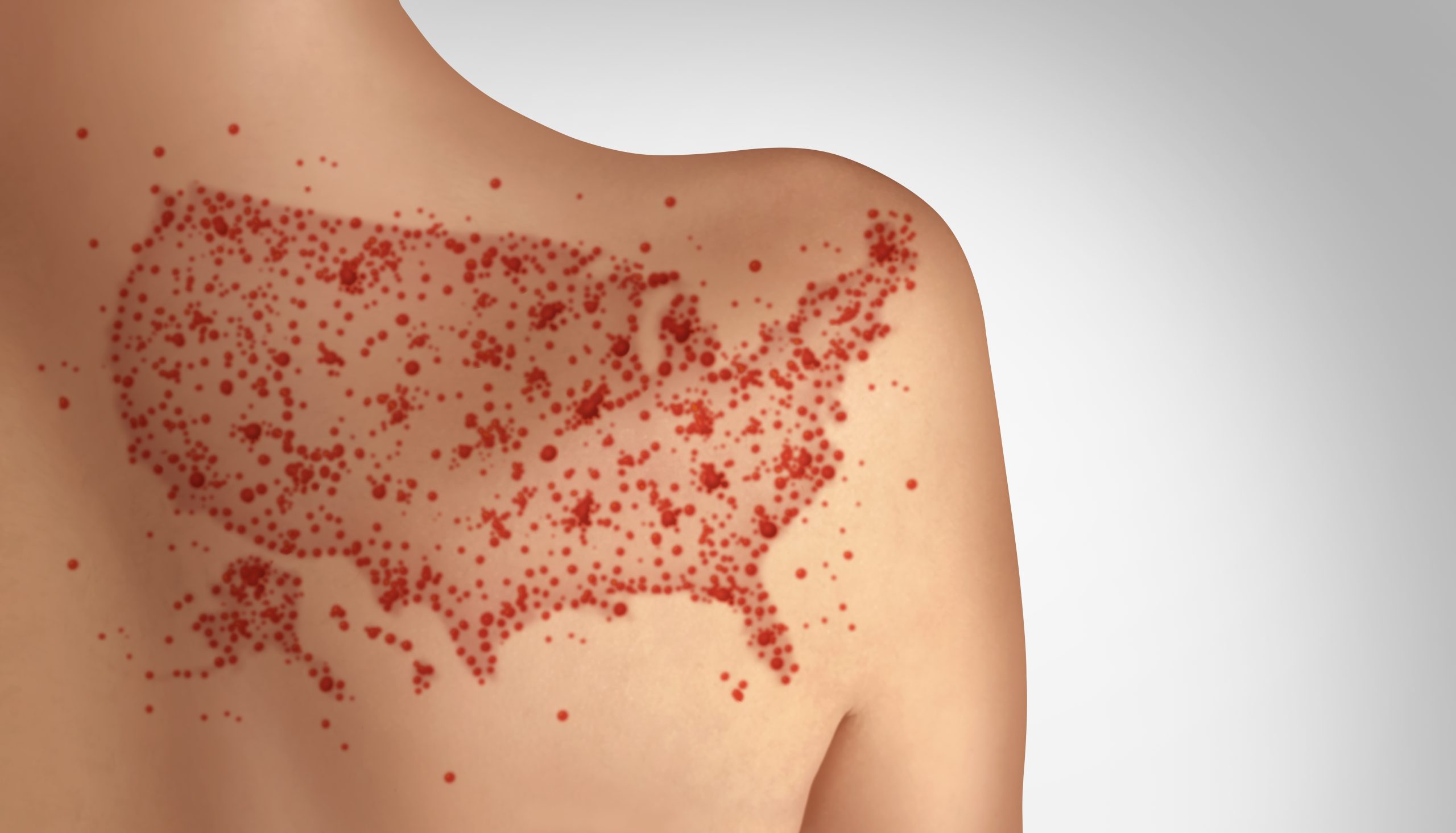Health Officials Warn After Measles Found at Two Major US Airports