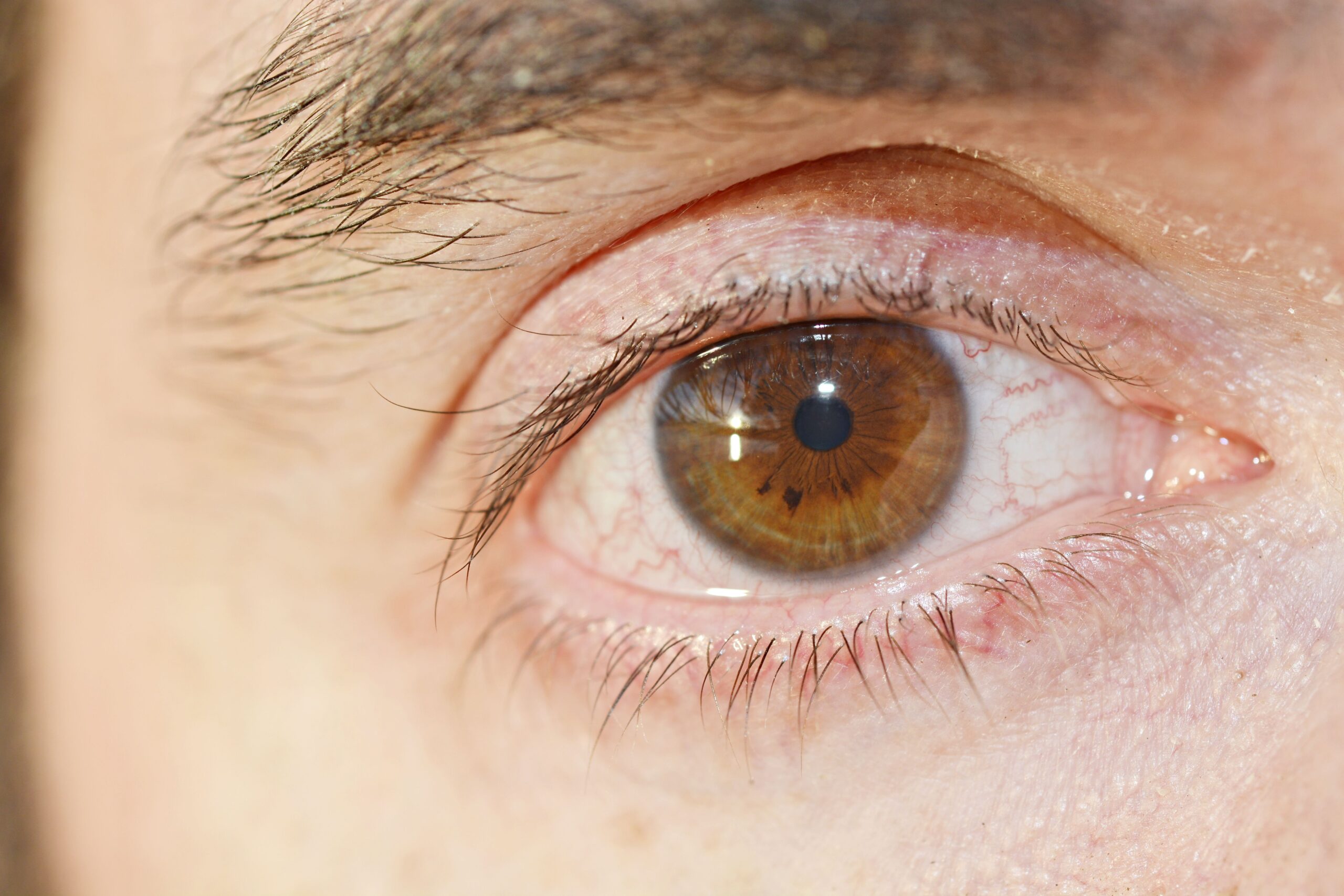 Mother Fighting to Save Her Eye After a Rare Parasite Invaded Her Cornea