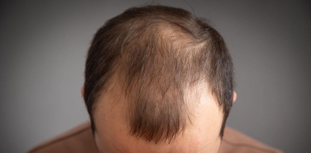 He Spent $17,500 On A Hair Transplant, Then Woke Up Looking Like An Egg