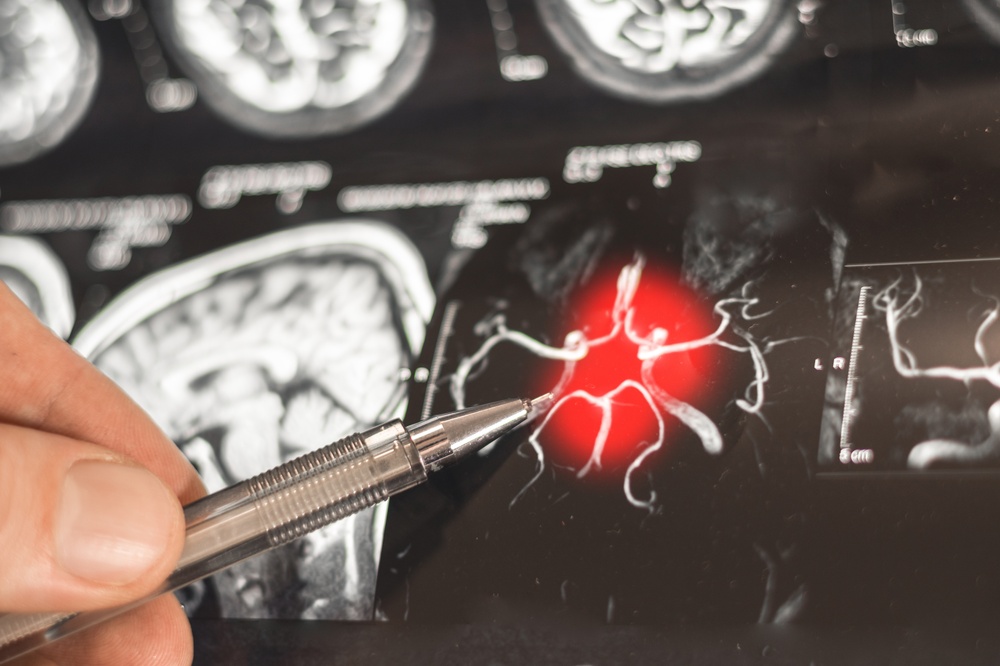 Scientists Found Something Strange About Lithium in Nearly 400 Human Brains