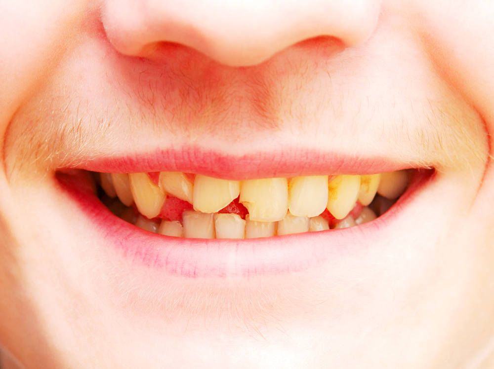 Woman’s Fake Rotten Teeth Trick Has Women Saying They’d Try Anything for a Peaceful Night Out