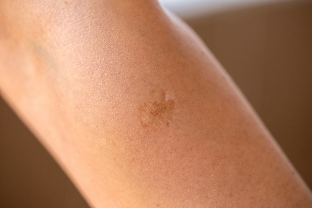 The Mystery Behind The Tiny Scar Millions Have On Their Arms