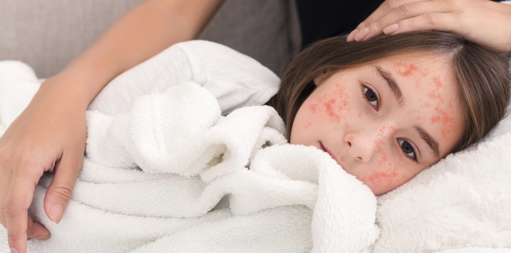 America’s Measles Surge Has Reached A Level Not Seen In 35 Years
