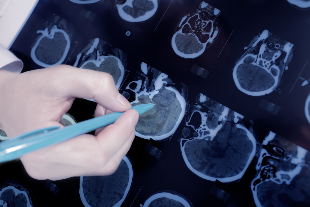 Scientists Found a Possible Weak Spot in Parkinson’s Disease, And a Cancer Drug May Already Target It