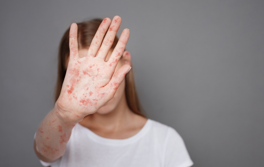 Measles Cases Are Surging Across America, And Babies Could Be Exposed Before Birth